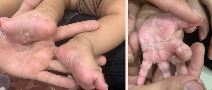 Bé trai 3 tháng tuổi bong vảy chân tay vì lây bệnh giang mai từ mẹ - Ảnh 1. Lòng bàn tay, bàn chân trẻ bong tróc vảy do mắc bệnh giang mai bẩm sinh - Ảnh: BVCC